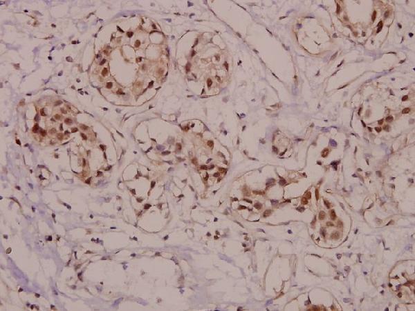 Immunohistochemistry (IHC) analyzes of p-VASP (S157) pAb in paraffin-embedded human breast carcinoma tissue at 1:50