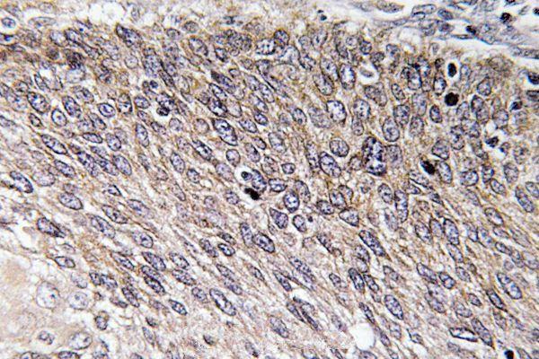 Immunohistochemistry (IHC) analyzes of p-VASP (S238) pAb in paraffin-embedded human cervix carcinoma tissue