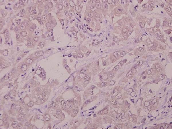 Immunohistochemistry (IHC) analyzes of IFN-R1 (L461) pAb in paraffin-embedded human colorectal carcinoma tissue at 1:50