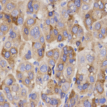 Immunohistochemistry (IHC) analysis of IFN-R1 polyclonal antibody in paraffin-embedded Human Liver Cancer tissue