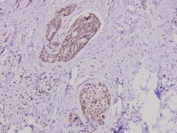Immunohistochemistry (IHC) analyzes of PI3K p85 α/γ (Y463) pAb in paraffin-embedded human breast carcinoma tissue at 1:100