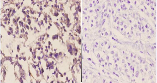 Immunohistochemistry (IHC) analyzes of CYP3A4/5 (F386) pAb in paraffin-embedded human liver carcinoma tissue at 1:50