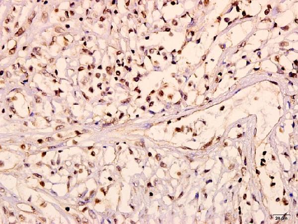 Immunohistochemistry (IHC) analyzes of Ob-R (L662) pAb in paraffin-embedded human breast carcinoma tissue at 1:50