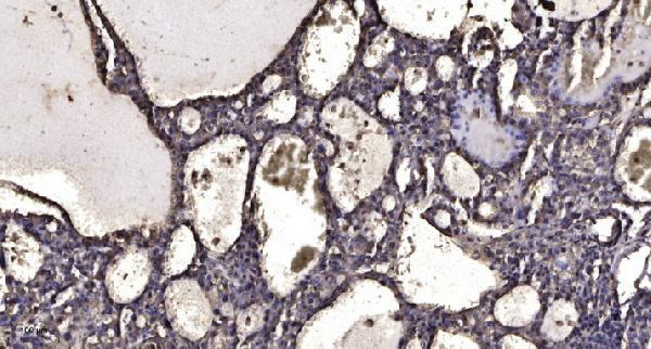 Immunohistochemical analysis of paraffin-embedded human liver cancer