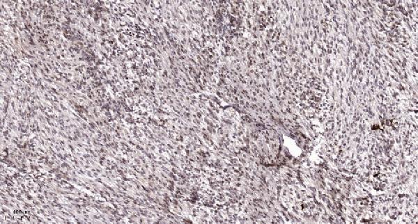 Immunohistochemical analysis of paraffin-embedded human Colon cancer