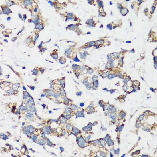 Immunohistochemistry of paraffin-embedded human gastric cancer using TSC1 antibody  at dilution of 1:200 
