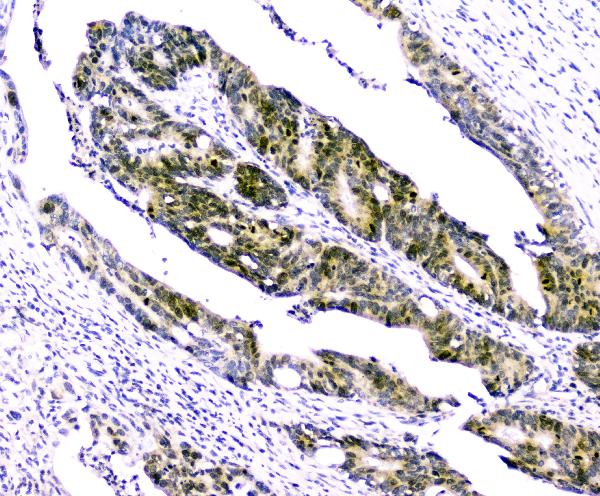 IHC analysis of Survivin using anti-Survivin antibody (A00379). Survivin was detected in paraffin-embedded section of human intestinal cancer tissues. Heat mediated antigen retrieval was performed in citrate buffer (pH6, epitope retrieval solution) for 20 mins. The tissue section was blocked with 10% goat serum. The tissue section was then incubated with 1μg/ml rabbit anti-Survivin Antibody (A00379) overnight at 4°C. Biotinylated goat anti-rabbit IgG was used as secondary antibody and incubated for 30 minutes at 37°C. The tissue section was developed using Strepavidin-Biotin-Complex (SABC)(Catalog # SA1022) with DAB as the chromogen.