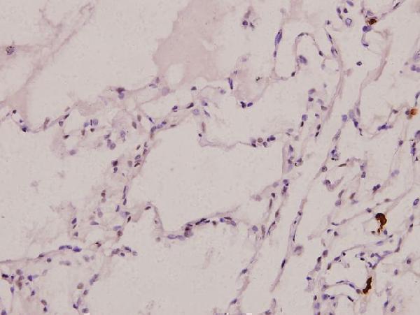 Immunohistochemistry (IHC) analyzes of p-C/EBP α (S21) pAb in paraffin-embedded human lung carcinoma tissue at 1:100