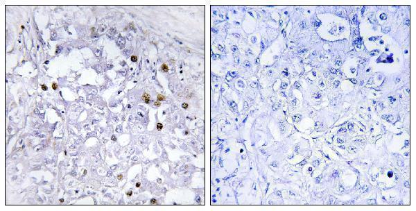 Immunohistochemistry analysis of paraffin-embedded human liver carcinoma, using HNF4 alpha (Phospho-Ser313) Antibody