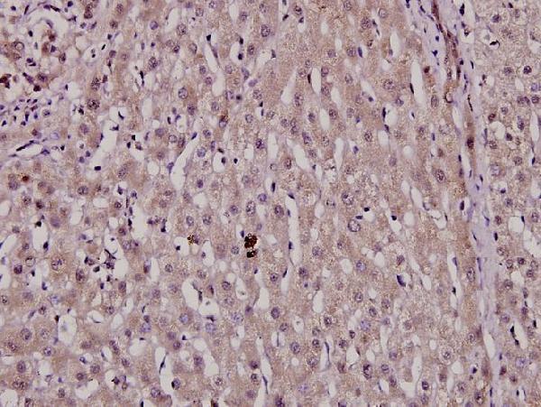 Immunohistochemistry (IHC) analyzes of p-HNF4-α (S313) pAb in paraffin-embedded human liver cancer tissue