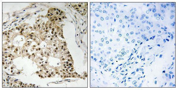 Immunohistochemistry analysis of paraffin-embedded human breast carcinoma, using Retinoic Acid Receptor alpha (Phospho-Ser77) Antibody