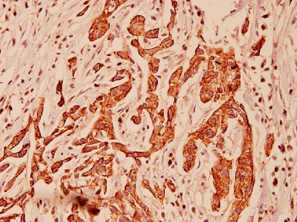 Immunohistochemistry (IHC) analyzes of Cytokeratin 5 (S573) pAb in paraffin-embedded human breast carcinoma tissue at 1:100