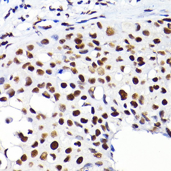 Immunohistochemistry of paraffin-embedded human breast cancer using KAP1/KAP1/TRIM28 Rabbit pAb  at dilution of 1:200 