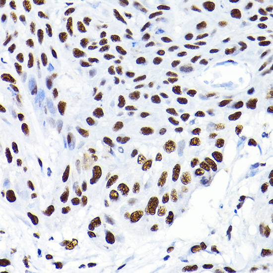 Immunohistochemistry of paraffin-embedded human esophageal cancer using KAP1/KAP1/TRIM28 Rabbit pAb  at dilution of 1:200 