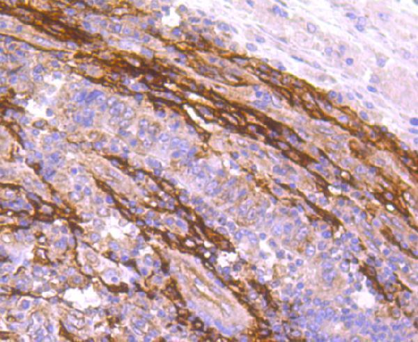 Immunohistochemical analysis of paraffin-embedded human colon cancer tissue using anti-FAP1 antibody