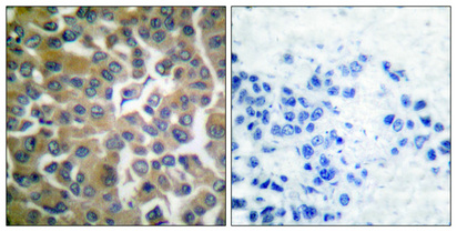 Immunohistochemistry analysis of paraffin-embedded human breast carcinoma tissue, using FAP-1 Antibody