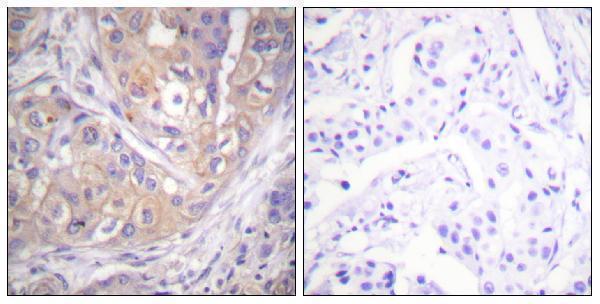 Immunohistochemistry analysis of paraffin-embedded human breast carcinoma, using Lck (Phospho-Tyr505) Antibody