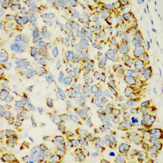 Immunohistochemistry of paraffin-embedded human esophageal cancer using CHIA antibody  at dilution of 1:100 