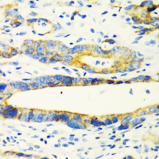 Immunohistochemistry of paraffin-embedded human gastric cancer using CHIA antibody  at dilution of 1:100 