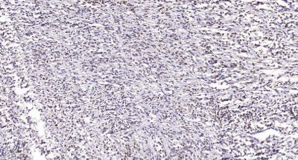 Immunohistochemical analysis of paraffin-embedded human Small intestinal stromal tumor