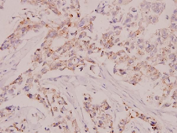 Immunohistochemistry (IHC) analyzes of Raf-1 (Q253) pAb in paraffin-embedded human breast carcinoma tissue at 1:100