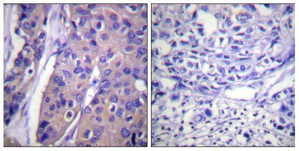 Immunohistochemistry analysis of paraffin-embedded human breast carcinoma, using C-RAF (Phospho-Ser296) Antibody