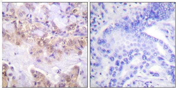 Immunohistochemistry analysis of paraffin-embedded human lung carcinoma, using C-RAF (Phospho-Ser621) Antibody