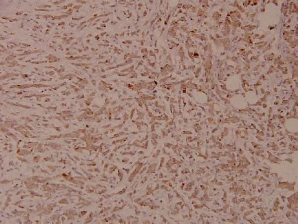 Immunohistochemistry (IHC) analyzes of p-Insulin Receptor (Y1355) pAb in paraffin-embedded human breast carcinoma tissue at 1:100