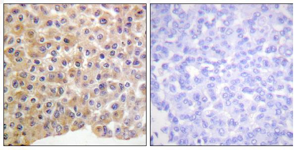 Immunohistochemistry analysis of paraffin-embedded human breast carcinoma, using IR (Phospho-Tyr1361) Antibody