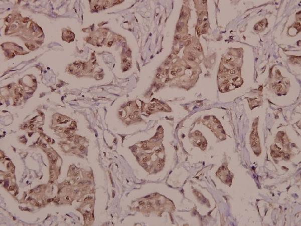 Immunohistochemistry (IHC) analyzes of p-PPARγ (S112) pAb in paraffin-embedded human breast carcinoma tissue at 1:50