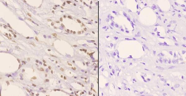 Immunohistochemistry (IHC) analyzes of p-NPM (T199) pAb in paraffin-embedded human kidney carcinoma tissue at 1:50