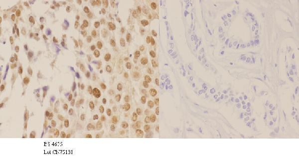 Immunohistochemistry (IHC) analyzes of p-NPM (T199) pAb in paraffin-embedded human breast carcinoma tissue at 1:50
