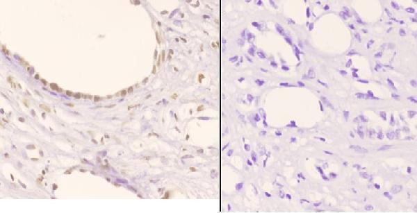 Immunohistochemistry (IHC) analyzes of p-NPM (T234) pAb in paraffin-embedded human kidney carcinoma tissue at 1:50