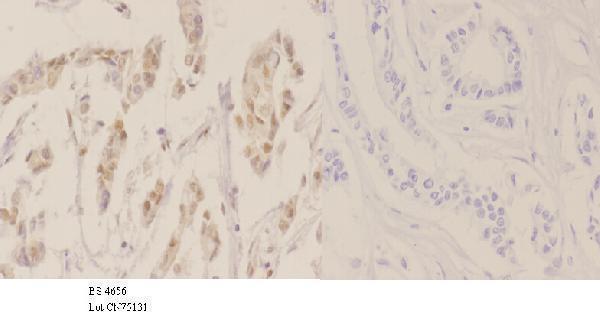 Immunohistochemistry (IHC) analyzes of p-NPM (T234) pAb in paraffin-embedded human breast carcinoma tissue at 1:50