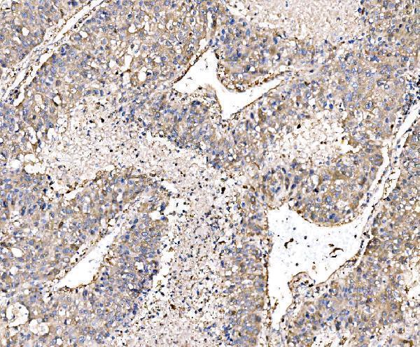  IHC analysis of PAK1 using anti-PAK1 antibody (A00454-2)
