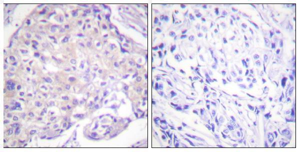 Immunohistochemistry analysis of paraffin-embedded human breast carcinoma, using PAK1 (Phospho-Thr212) Antibody