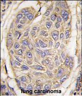 Formalin-fixed and paraffin-embedded human lung carcinoma tissue reacted with B2M antibody (C-term) (Cat