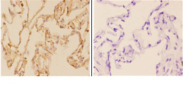 Immunohistochemistry (IHC) analyzes of ABCG2 (N338) pAb in paraffin-embedded human lung carcinoma tissue at 1:50,showing cytoplasmic staining