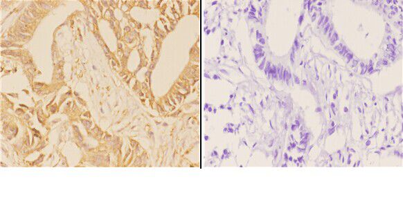 Immunohistochemistry (IHC) analyzes of ABCG2 (N338) pAb in paraffin-embedded human rectum carcinoma tissue at 1:50,showing cytoplasmic staining
