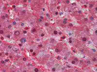 Immunohistochemistry (IHC) analysis of paraffin-embedded Human Liver Tissues with AEC staining using ApoA Monoclonal antibody