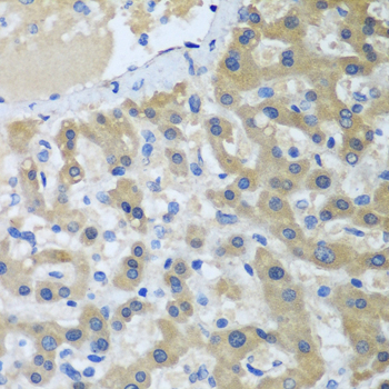 Immunohistochemistry of paraffin-embedded human colon carcinoma using XPC Rabbit pAb  at dilution of 1:100 