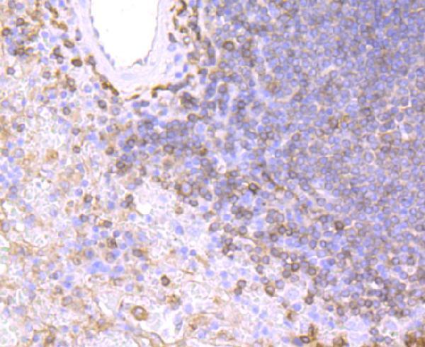 Immunohistochemistry of paraffin-embedded Human liver cancer using HLA-DPB1 antibody  at dilution of 1:100 