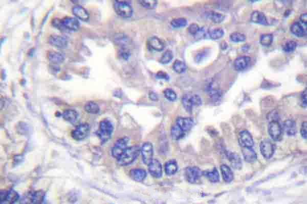 Immunohistochemistry (IHC) analyzes of p-Syk (Y348) pAb in paraffin-embedded human lung cancer tissue