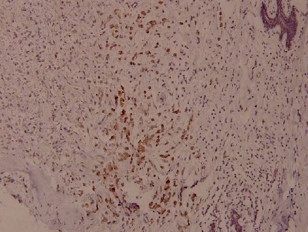 Immunohistochemistry (IHC) analyzes of p-Syk (Y525) pAb in paraffin-embedded human breast carcinoma tissue at 1:100