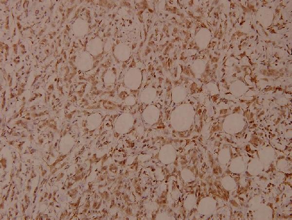 Immunohistochemistry (IHC) analyzes of p-Filamin 1 (S2152) pAb in paraffin-embedded human breast carcinoma tissue at 1:100