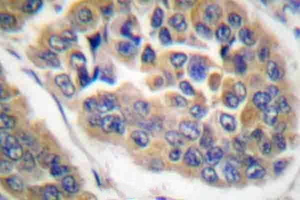 Immunohistochemistry (IHC) analyzes of p-GR (S211) pAb in paraffin-embedded human breast cancer tissue