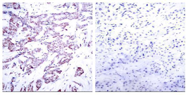Immunohistochemistry analysis of paraffin-embedded human breast carcinoma, using STAT6 (Phospho-Thr645) Antibody