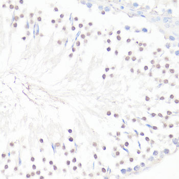 Immunohistochemistry of paraffin-embedded human breast cancer using GLI1 Rabbit pAb  at dilution of 1:150 
