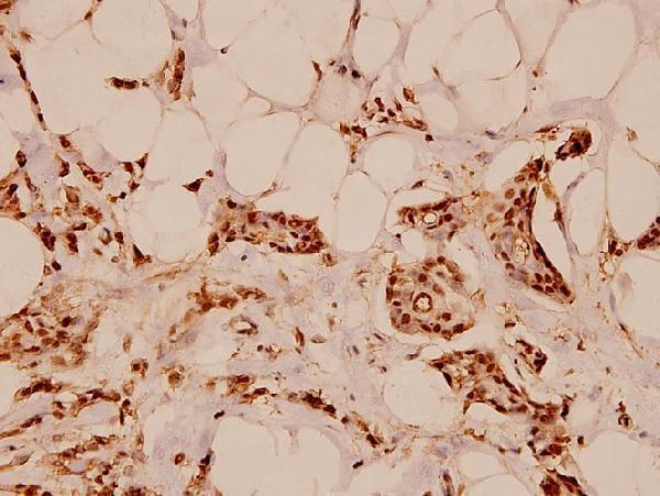 Immunohistochemistry (IHC) analyzes of ErbB-3 (S1285) pAb in paraffin-embedded human breast carcinoma tissue at 1:100