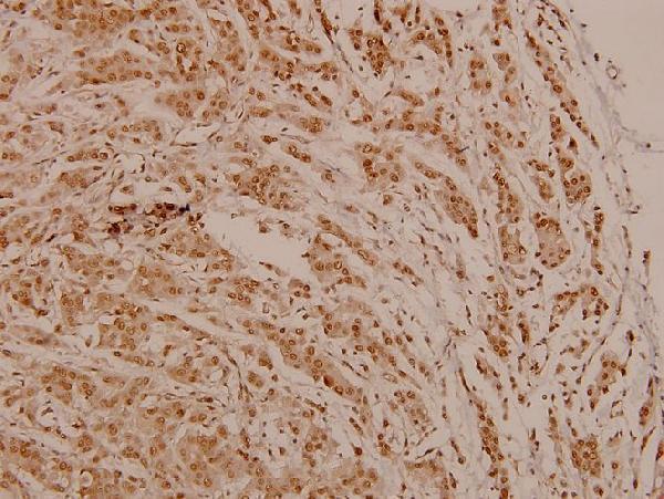 Immunohistochemistry (IHC) analyzes of p-PR (S190) pAb in paraffin-embedded human breast carcinoma tissue at 1:100